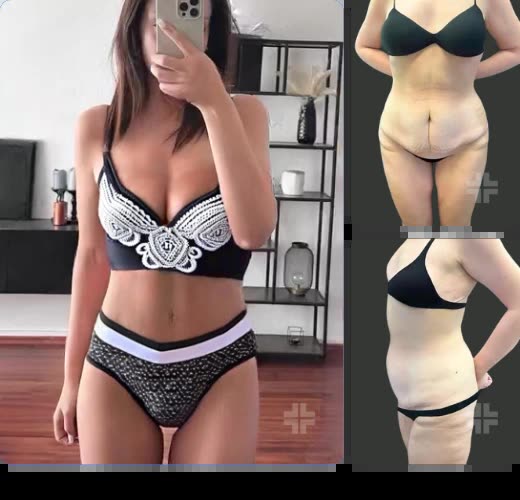 Tummy tuck, before and after