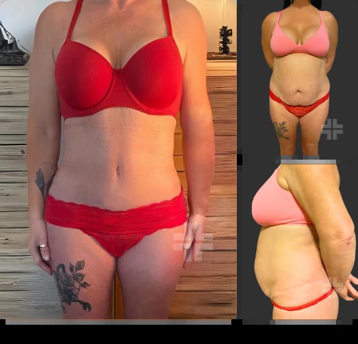 Tummy tuck, before and after