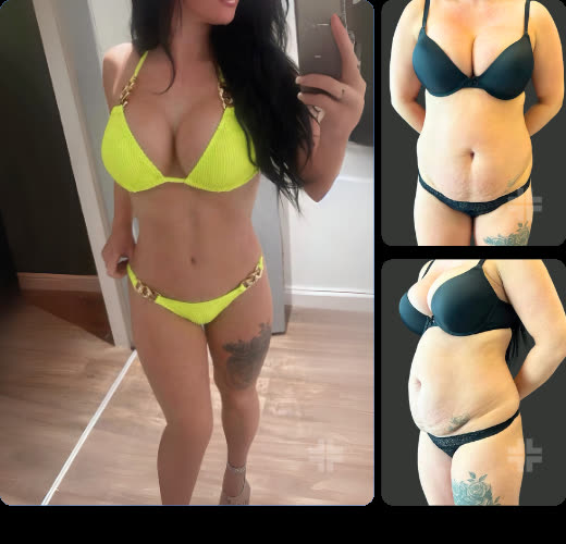 Tummy tuck, before and after