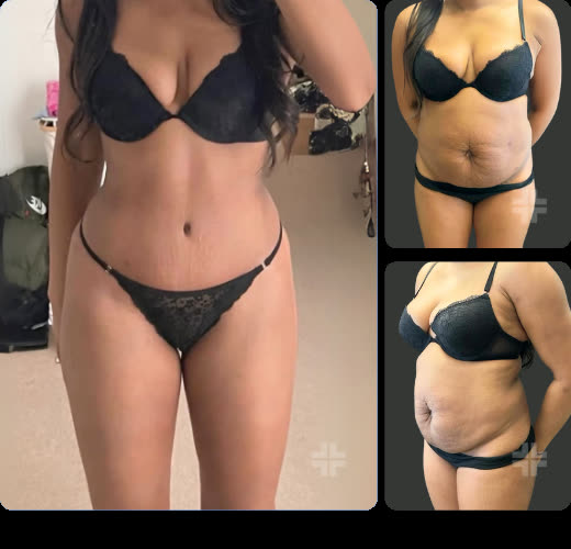 Tummy tuck, before and after