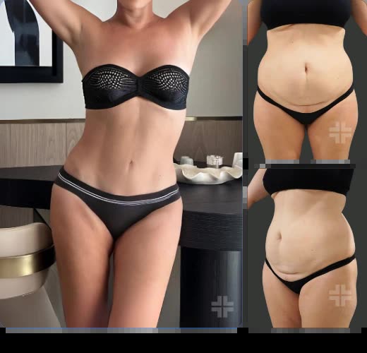 Tummy tuck, before and after