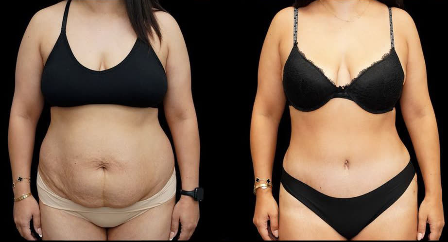 Tummy tuck, before and after