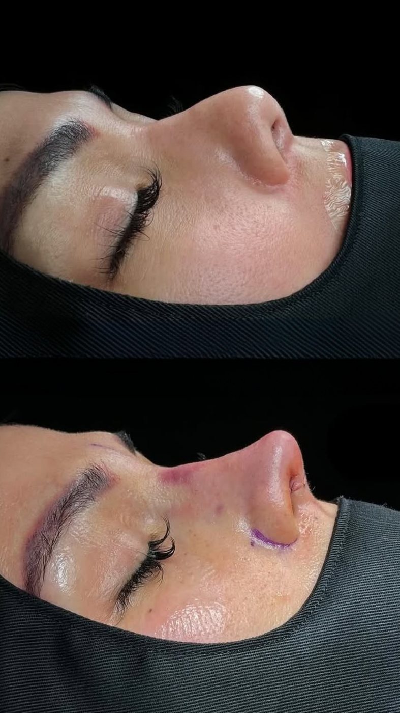 Rhinoplasty, before and after