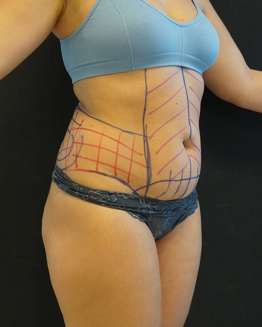 Body contouring result