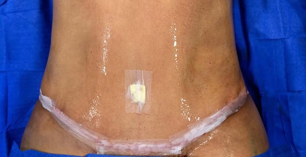 Where the scar actually sits