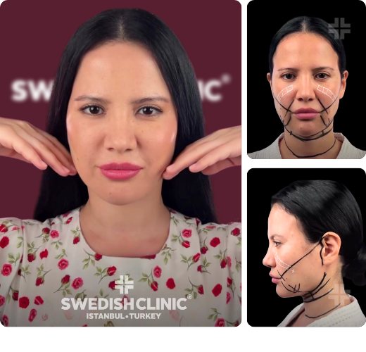 Deep-plane facelift, before and after