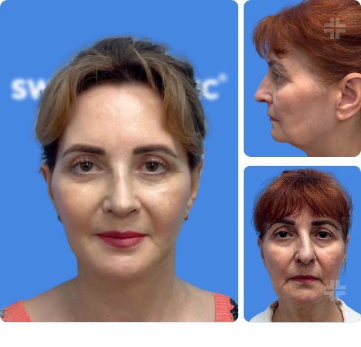 Deep-plane facelift, before and after