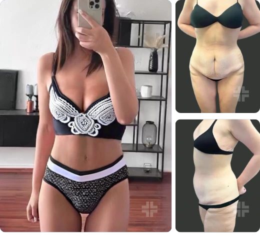 Tummy tuck, before and after