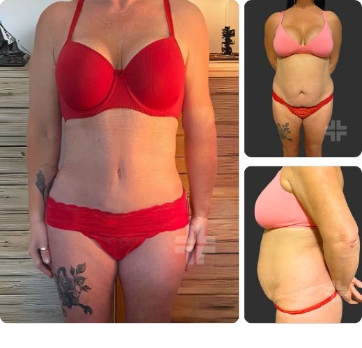 Tummy tuck, before and after