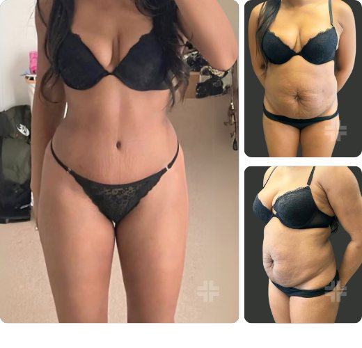 Tummy tuck, before and after