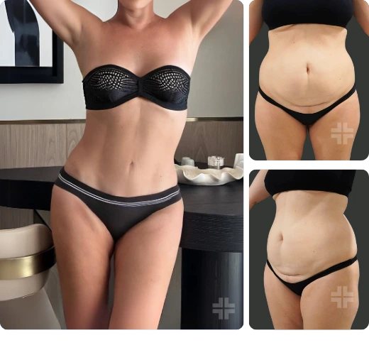 Tummy tuck, before and after