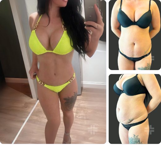 Tummy tuck, before and after