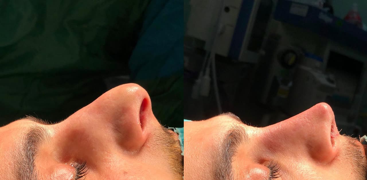 Rhinoplasty, before and after