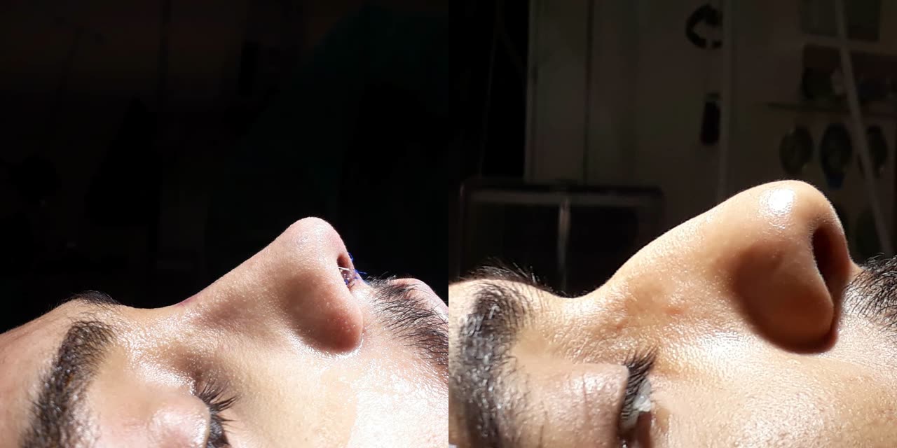 Rhinoplasty, before and after