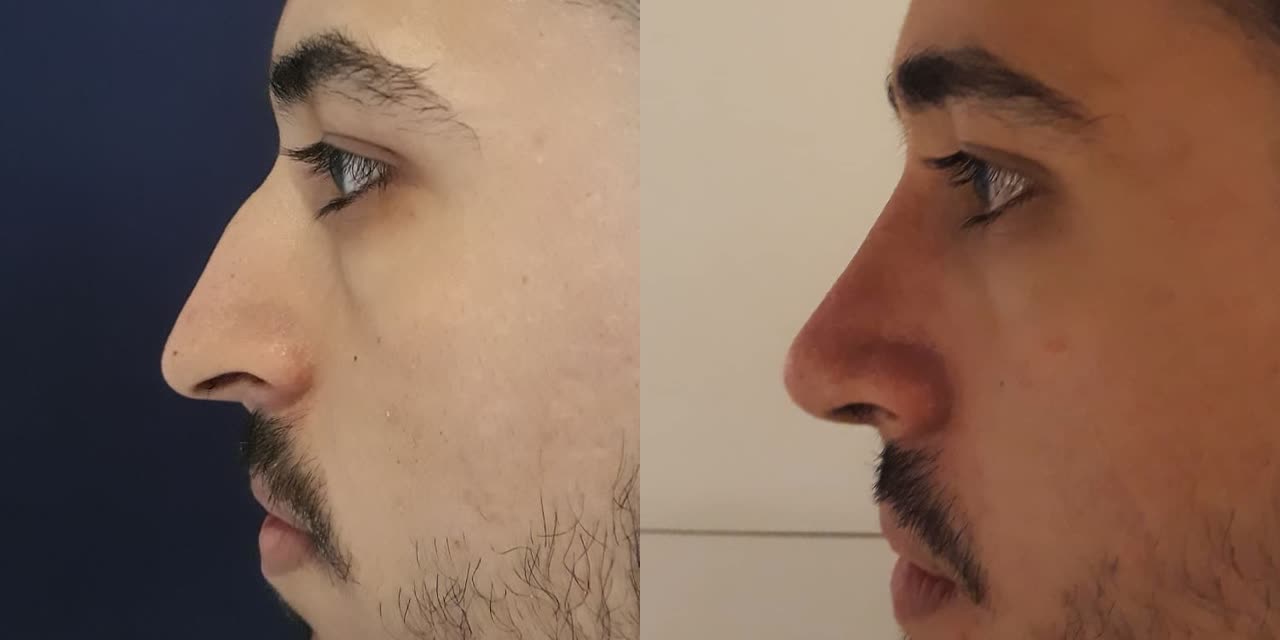 Rhinoplasty, before and after