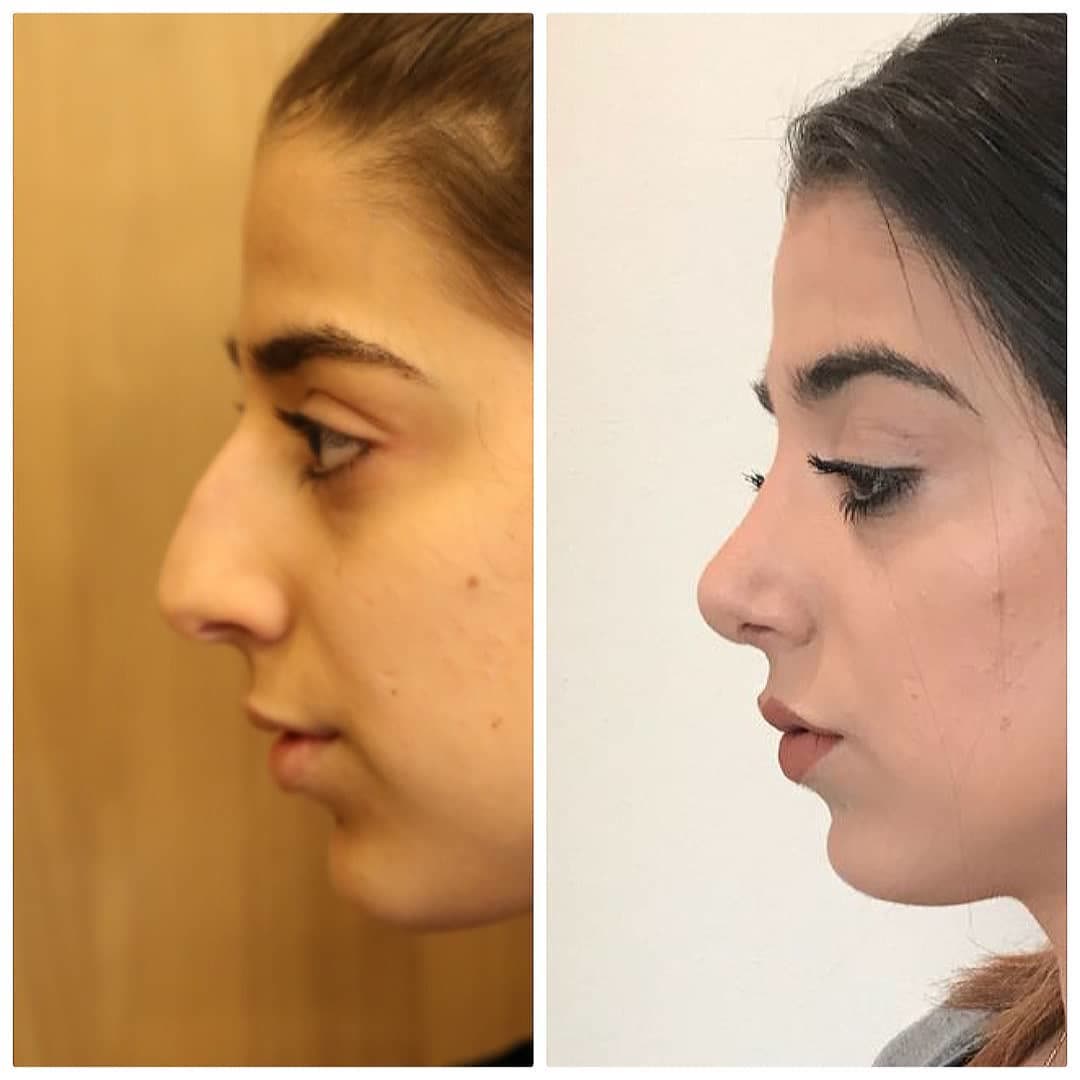 Rhinoplasty, before and after
