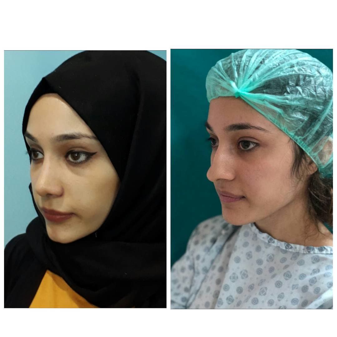 Rhinoplasty, before and after