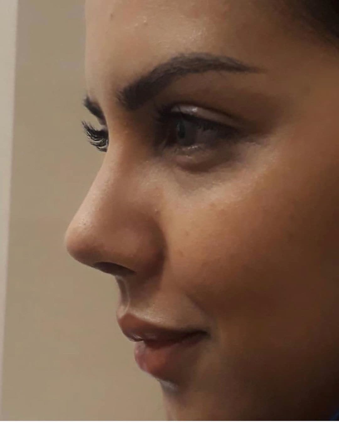 Rhinoplasty, before and after