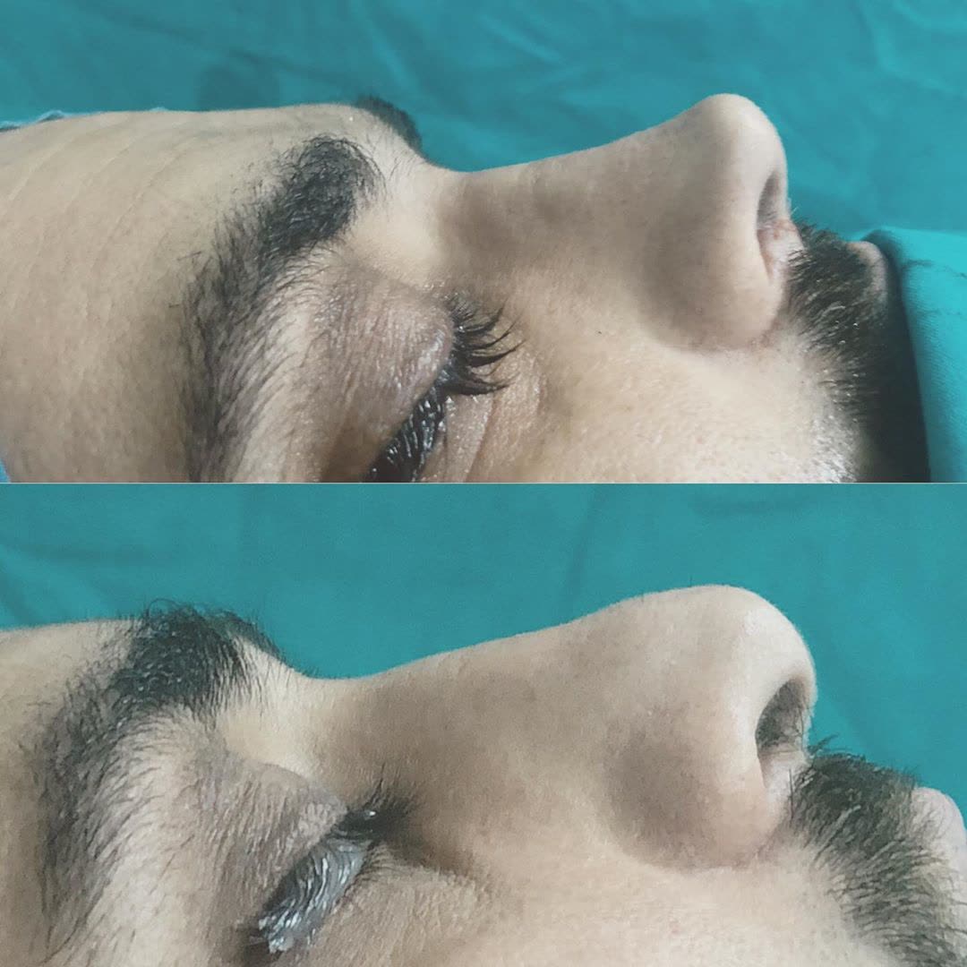Rhinoplasty, before and after
