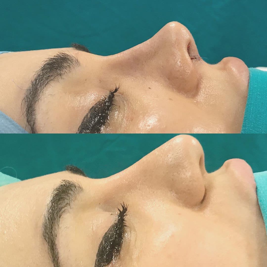 Rhinoplasty, before and after