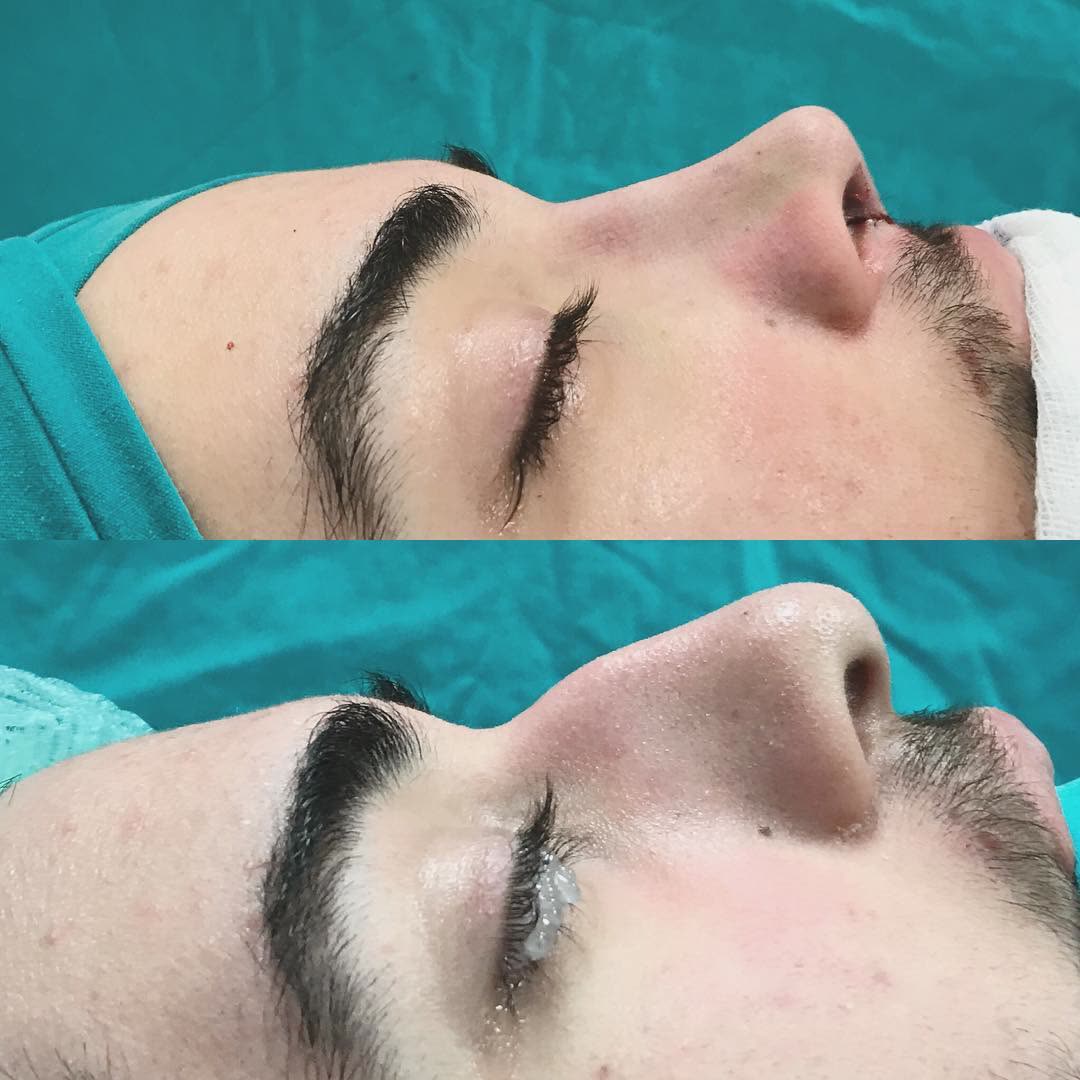 Rhinoplasty, before and after
