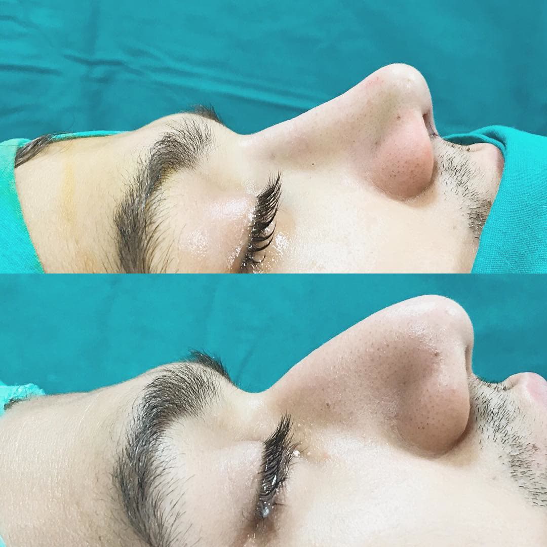 Rhinoplasty, before and after
