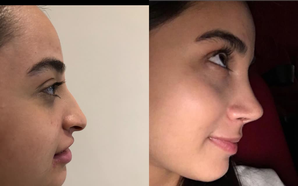 Rhinoplasty, before and after