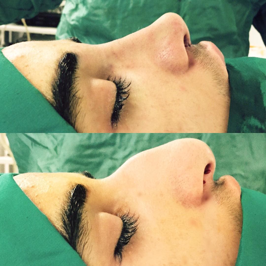 Rhinoplasty, before and after