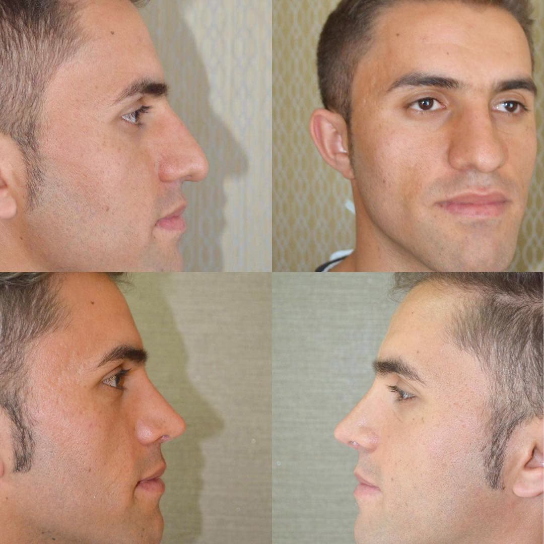 Rhinoplasty, before and after