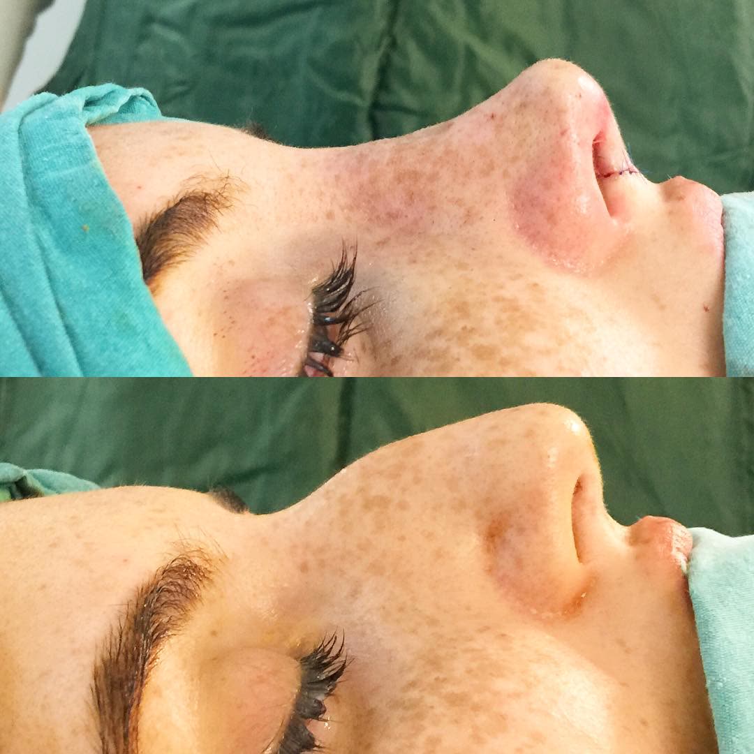 Rhinoplasty, before and after