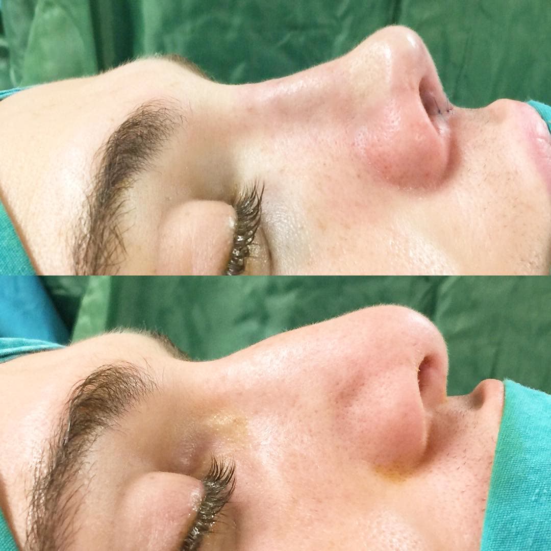 Rhinoplasty, before and after