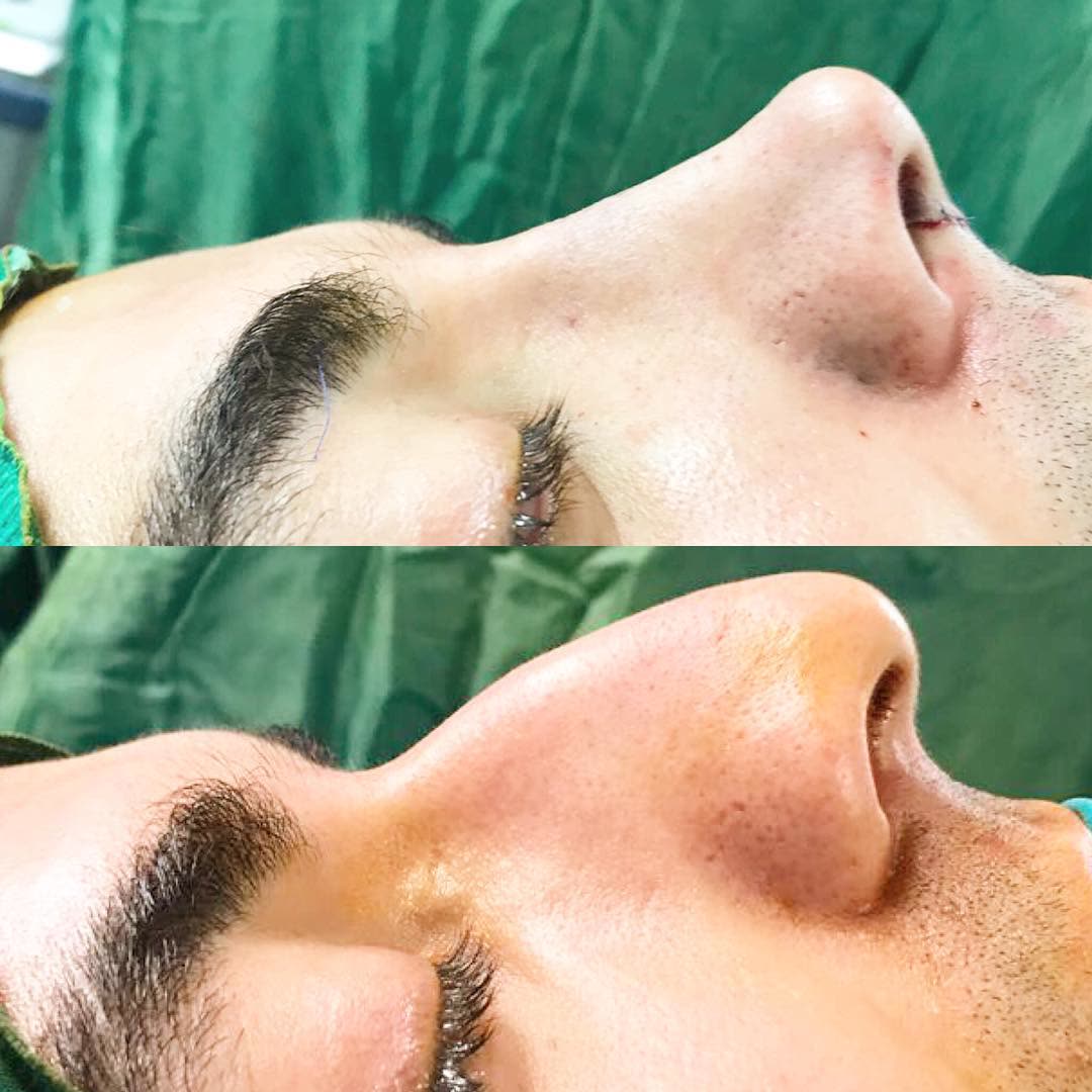 Rhinoplasty, before and after