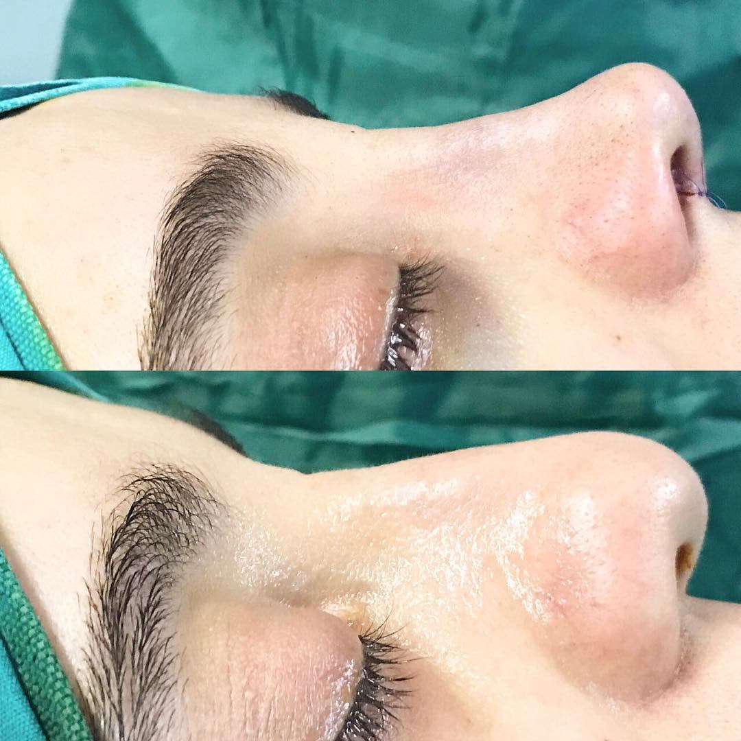 Rhinoplasty, before and after