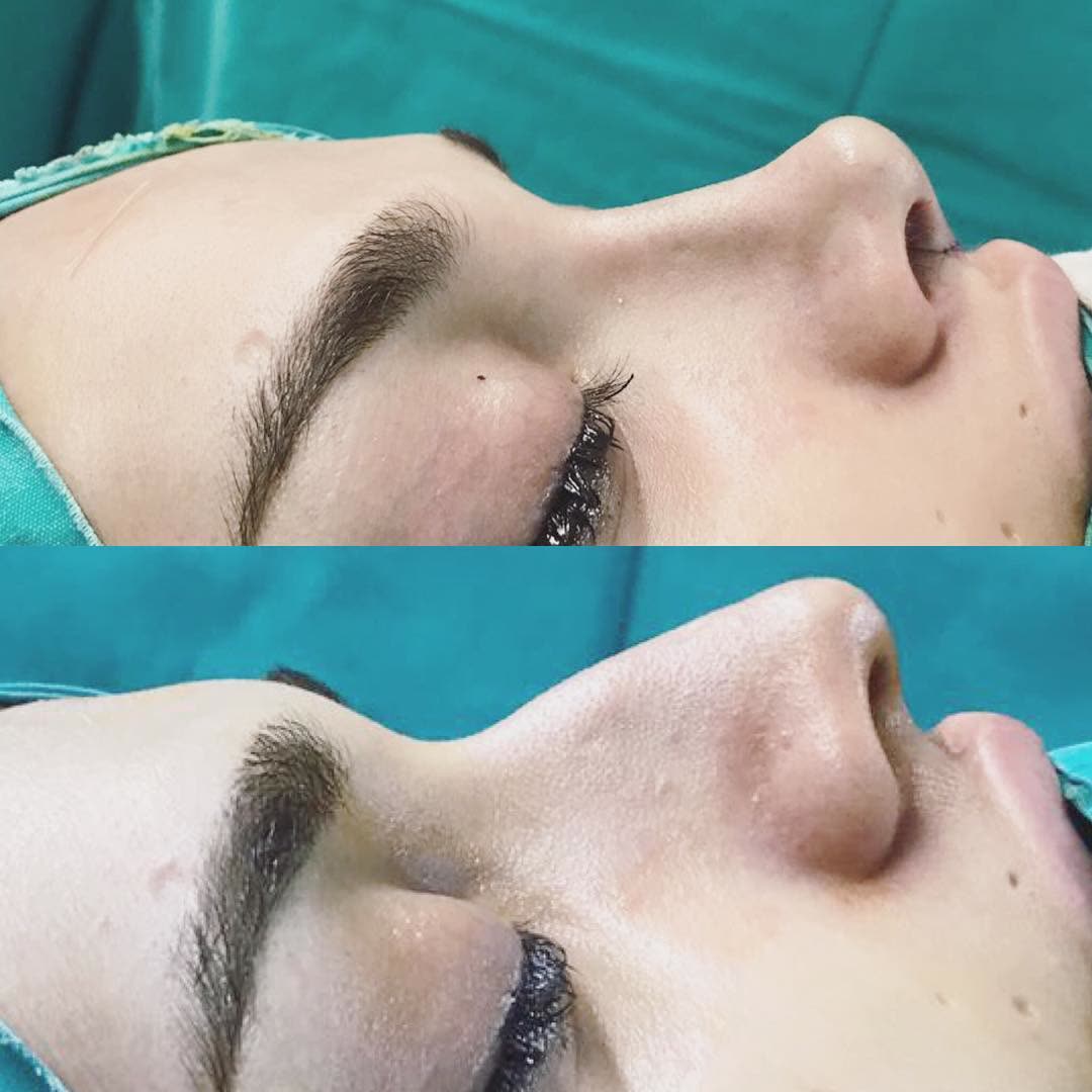Rhinoplasty, before and after