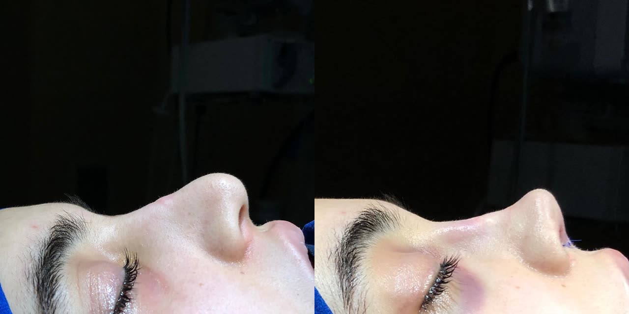 Rhinoplasty, before and after