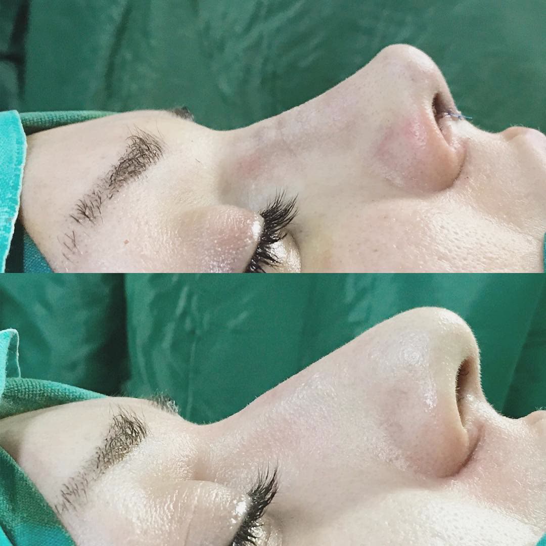 Rhinoplasty, before and after