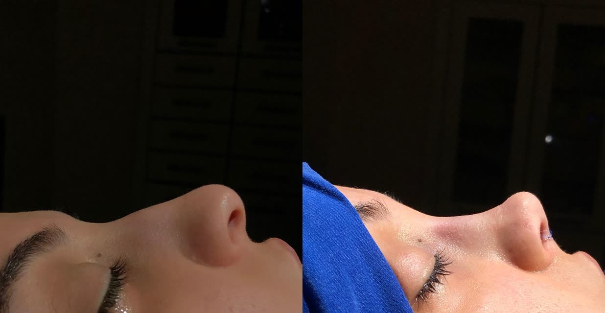 Rhinoplasty, before and after