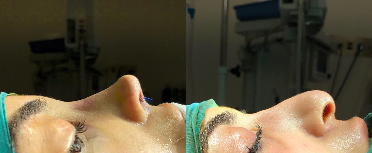 Rhinoplasty, before and after