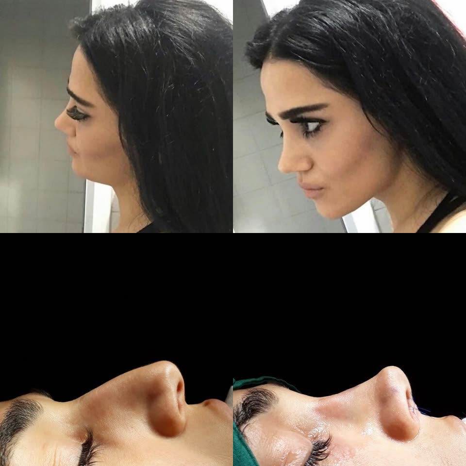 Rhinoplasty, before and after
