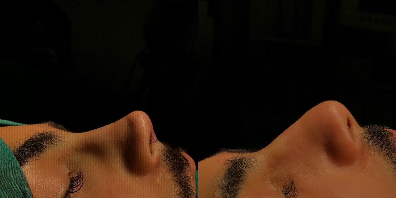 Rhinoplasty, before and after