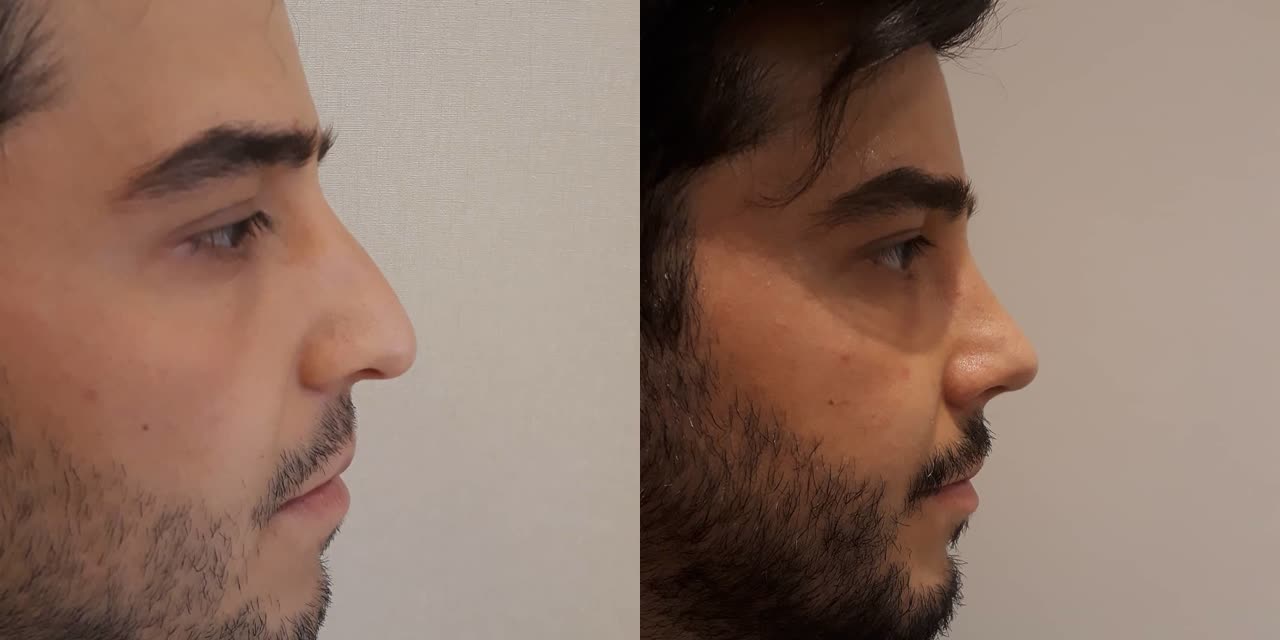 Rhinoplasty, before and after
