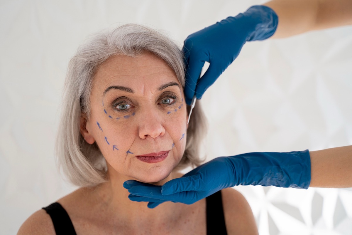 Deep-Plane Facelift