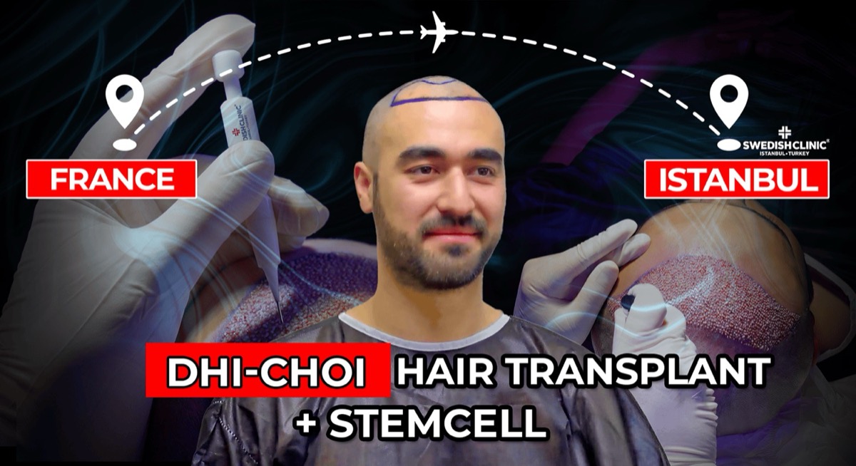 Trapianto di barba