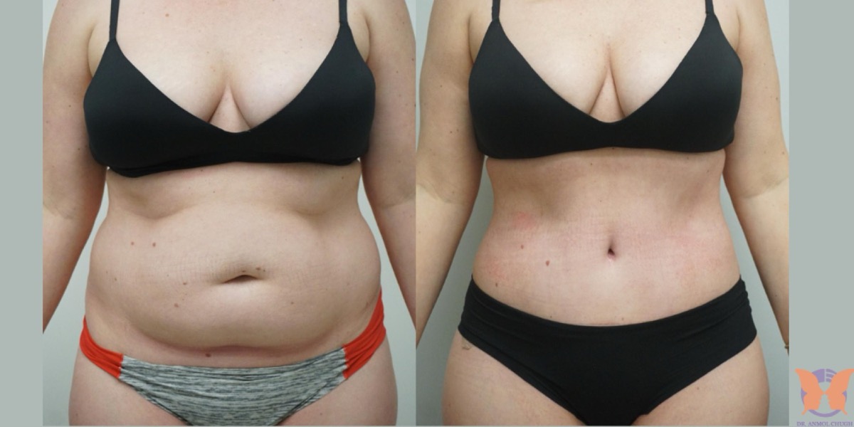Addominoplastica