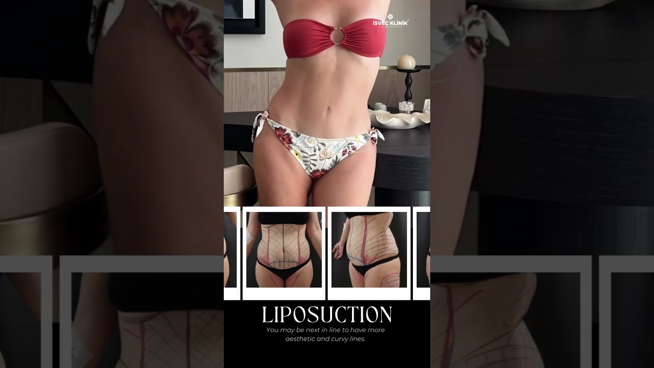 Liposuction — patient story