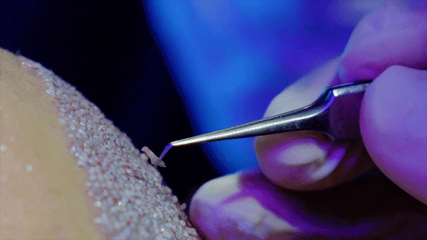 Sapphire FUE Hair Transplant Recovery Process